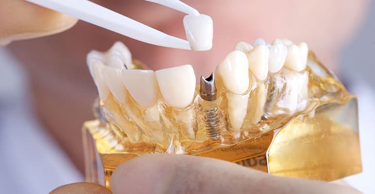 6 địa chỉ trồng răng implant tại hà nội uy tín nhất
