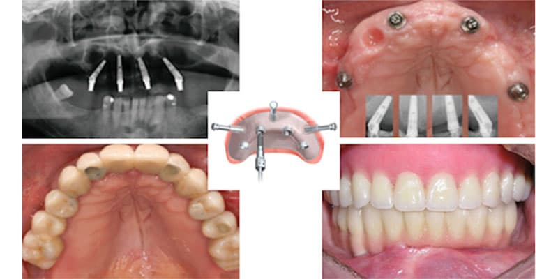 phương pháp phục hình khi mất nguyên hàm răng