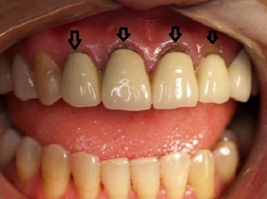 răng sứ chế tạo không chính xác gây viêm lợi sau khi bọc răng