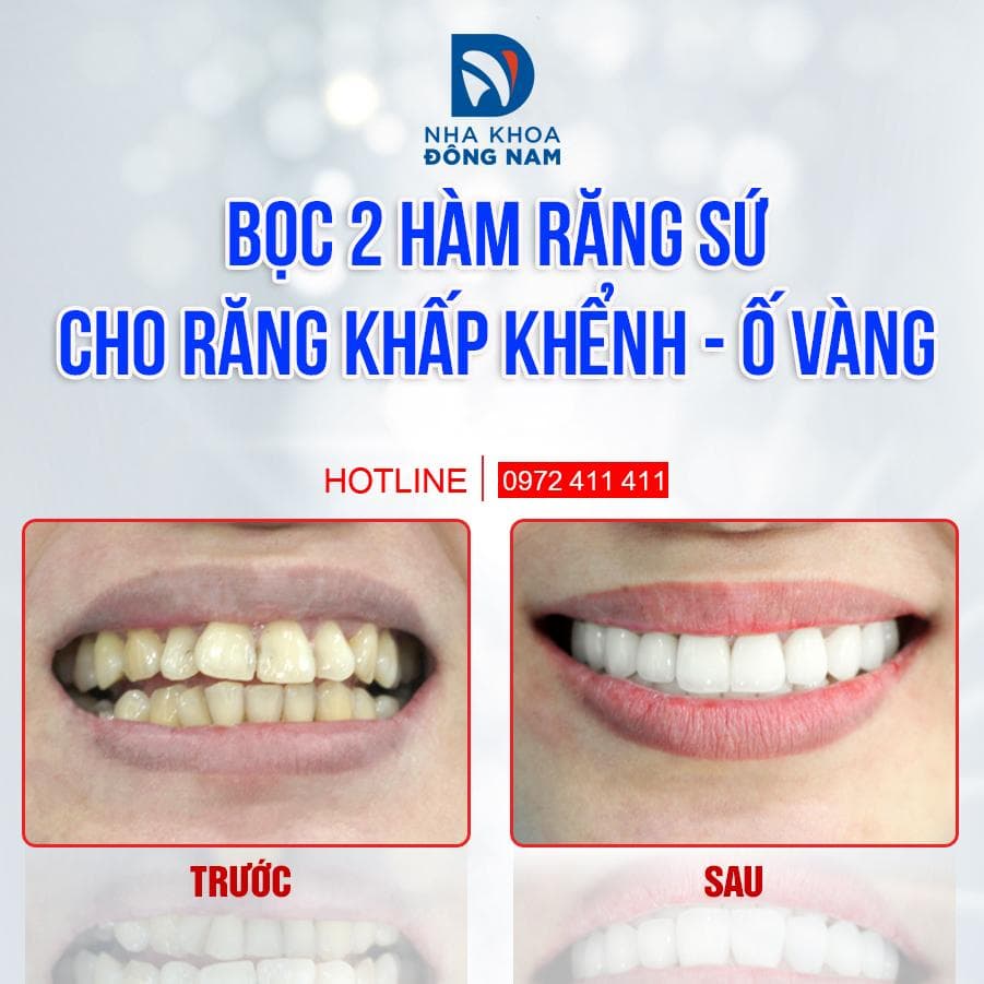 bọc răng sứ cho răng khấp khểnh ố vàng xmas 2021