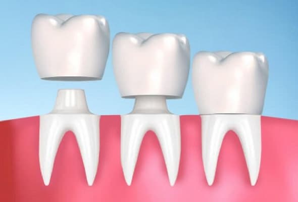 bọc răng sứ sai kỹ thuật gây nên tình trạng hôi miệng