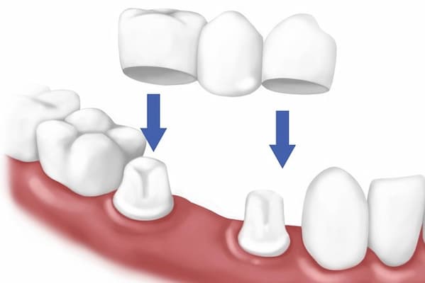 cầu răng sứ để trồng răng khi còn chân răng ngắn
