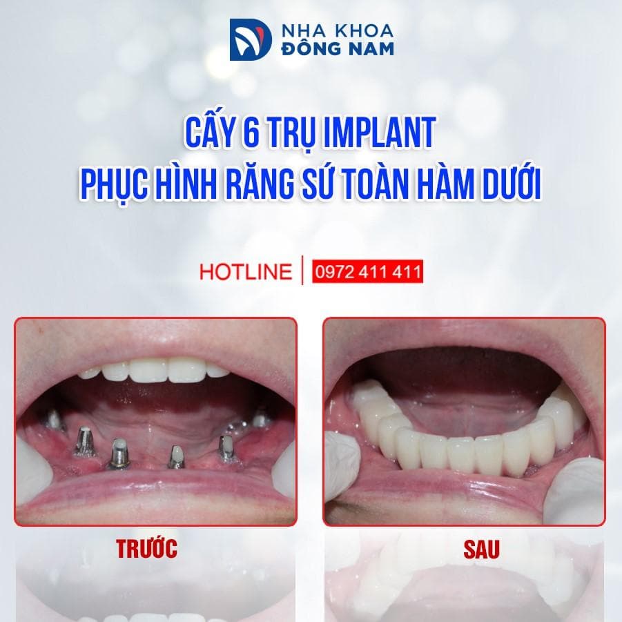 cấy 6 trụ implant phục hình răng sứ toàn hàm dưới xmas 2021
