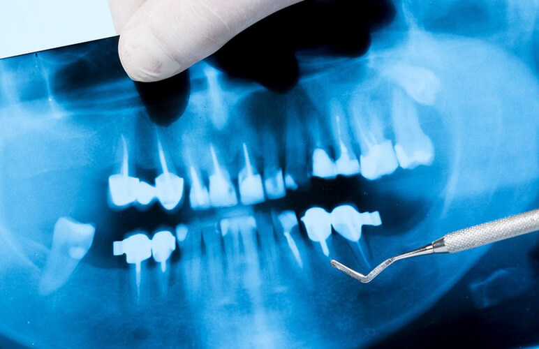 Chụp Ct Răng Giải Pháp Chẩn đoán Răng Miệng Hiệu Quả