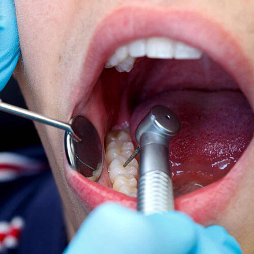 điều Trị Sâu Răng Tại Trung Tâm Nha Khoa Cấy Implant
