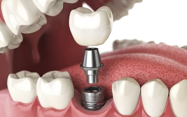 keo dán răng giả trồng răng implant