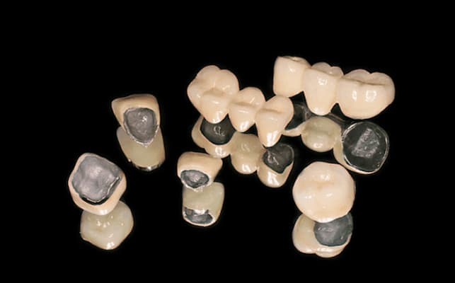 loại răng sứ kim loại là gì