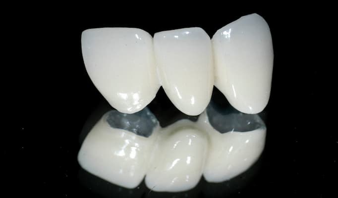 loại răng toàn sứ emax