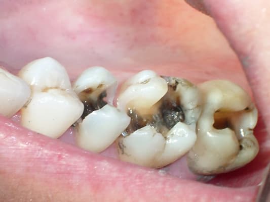 những trường hợp nên bọc răng sứ cho răng sâu