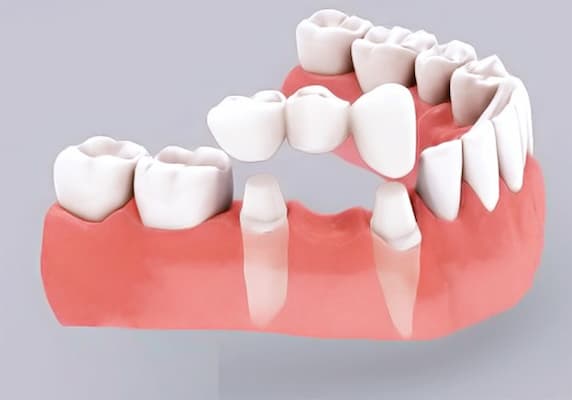 phục hình răng số 6 bằng phương pháp cầu răng sứ
