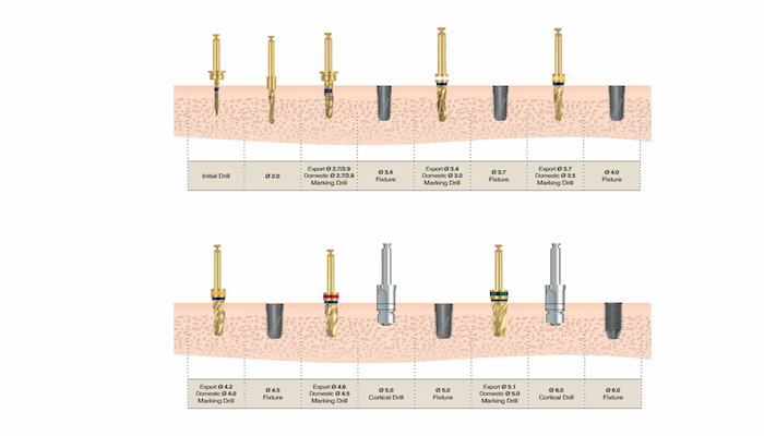 quy trình cấy implant biotem vào xương hàm