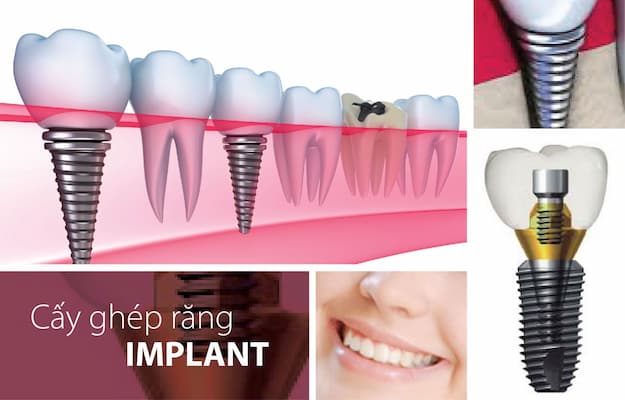 quy trình trồng răng implant như thế nào