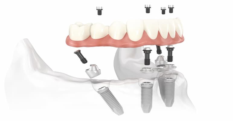 quy trình trồng răng implant tại trung tâm cấy implant
