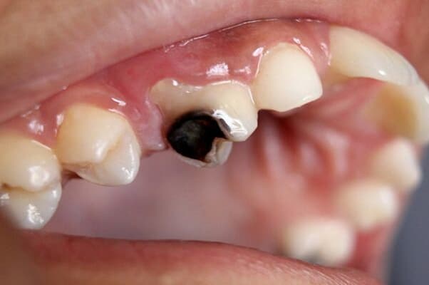 răng sâu bị vỡ có bọc sứ được không