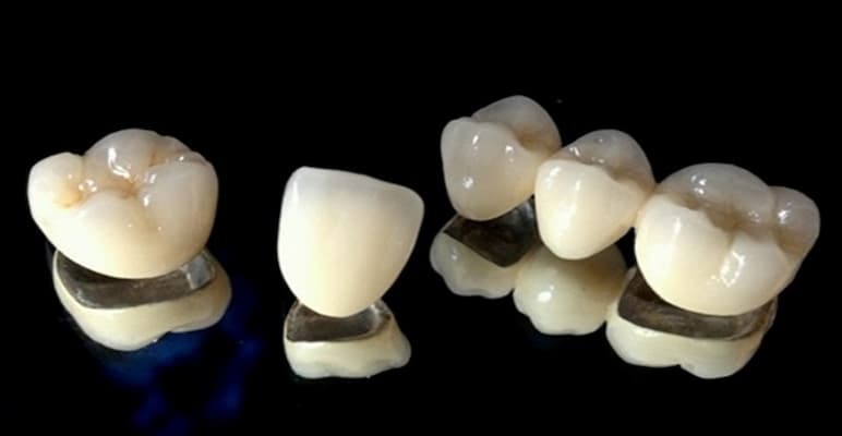 răng sứ kim loại phục hình thẩm mỹ