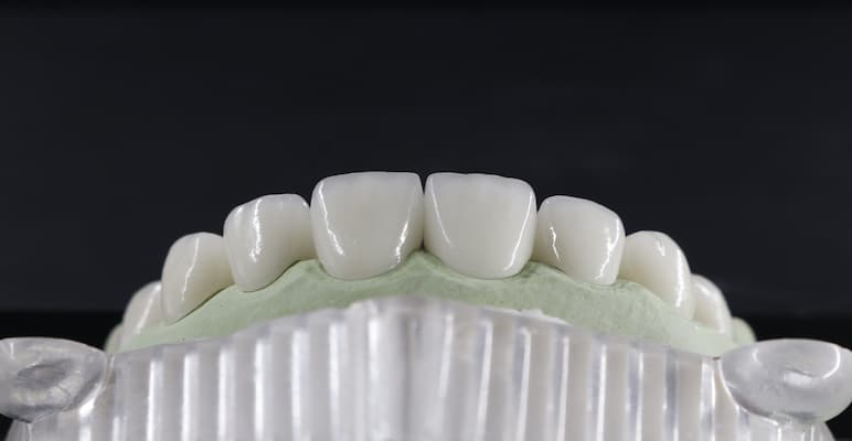 răng toàn sứ zirconia của đức