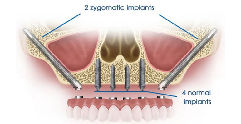 tìm hiểu về cấy ghép zygoma implant
