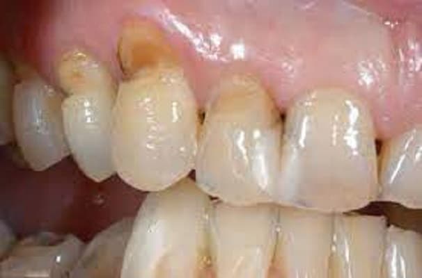 triệu chứng điển hình của mòn cổ chân răng
