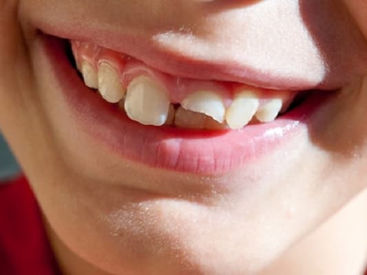 trồng răng khi còn chân răng dài