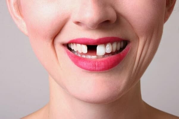 trồng răng khi còn chân răng ngắn