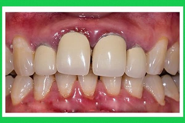 viêm lợi sau khi bọc răng do dị ứng với chất liệu làm răng sứ